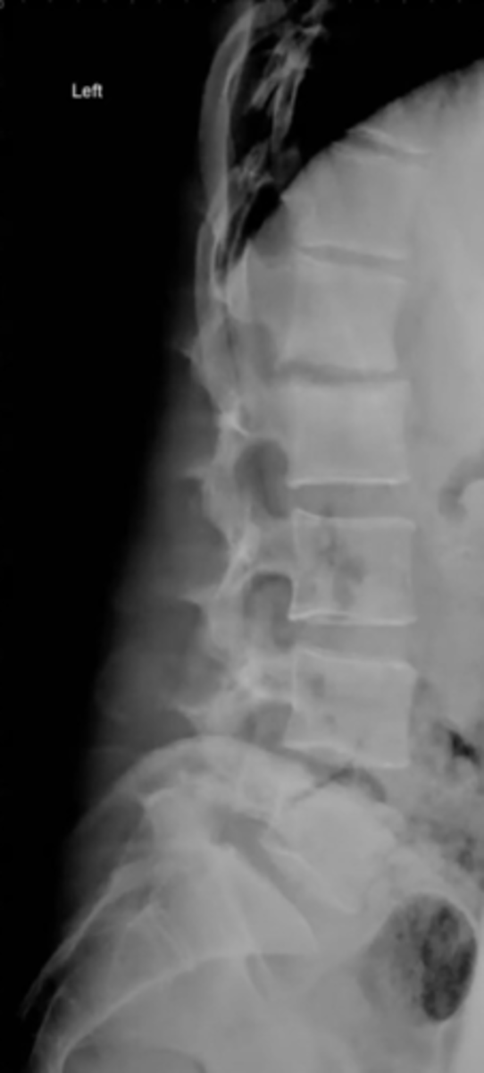 <p>What is this?</p><p>- Infection in disc</p>
