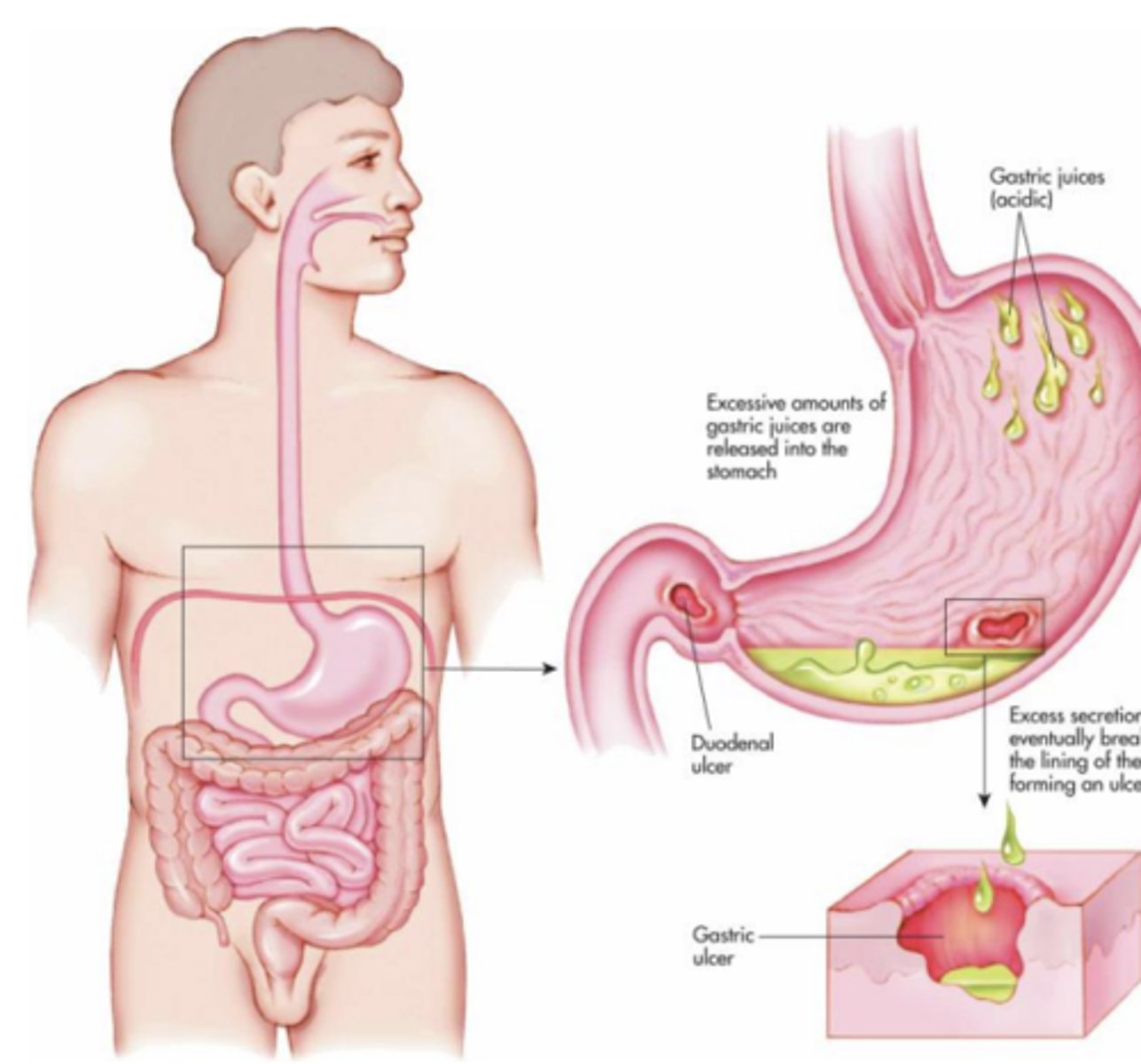 <p>- administered orally</p><p>- drugs are non-selective for muscarinic receptors, but effects likely on M1</p><p>- does not cross BBB</p><p>- mostly used or stomach spasms </p><p>ex: glycopyrrolate, propantheline, pirenzepine, methscopolamine </p>