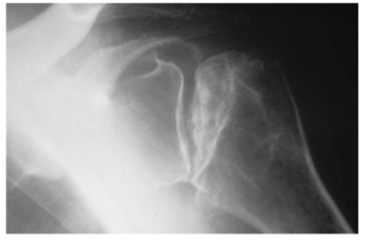 <p>x-ray has collapse and signs of cartilage damage (arthritis)</p>