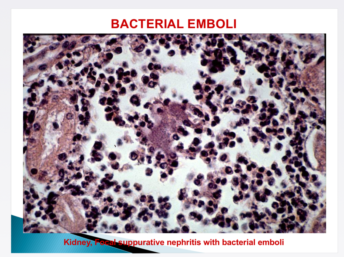 <p>Bacterial embolus in pulmonary + systemic circulation → embolic metastatic diseases (glomerulonephritis, pneumonia, hepatitis)</p>