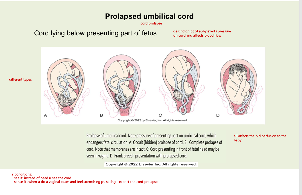 <p>A. occult (hidden) prolapse of cord</p><p>B complete prolapse of cord (membrane intact</p><p>C cord presenting infront of fetal head may be seen in vagina</p><p>D frank breech presentation with prolapsed cord</p>