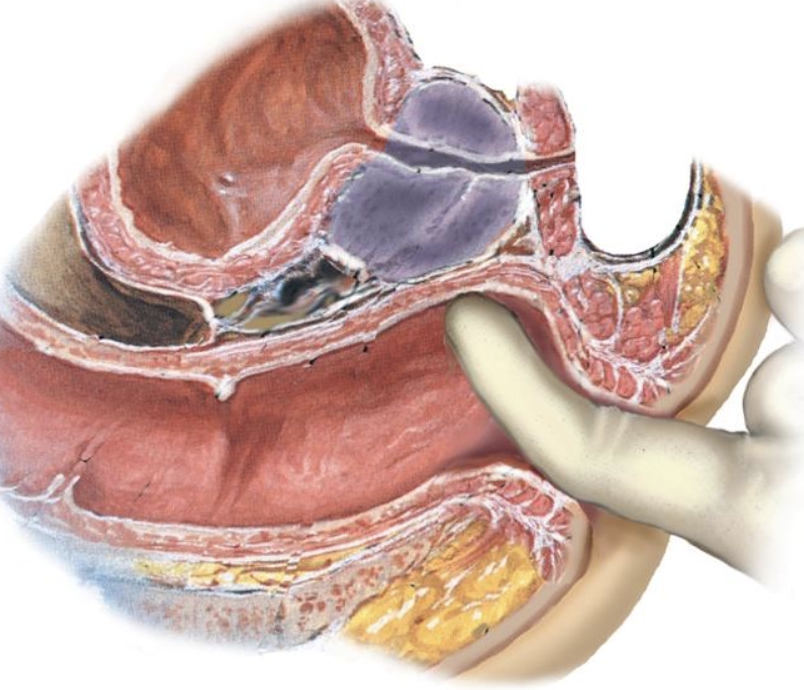 <p>Prostate is enlarged, smooth, firm, and slightly elastic</p><p>Median sulcus may not be palpable</p><p>Common in men older than 50 years</p>