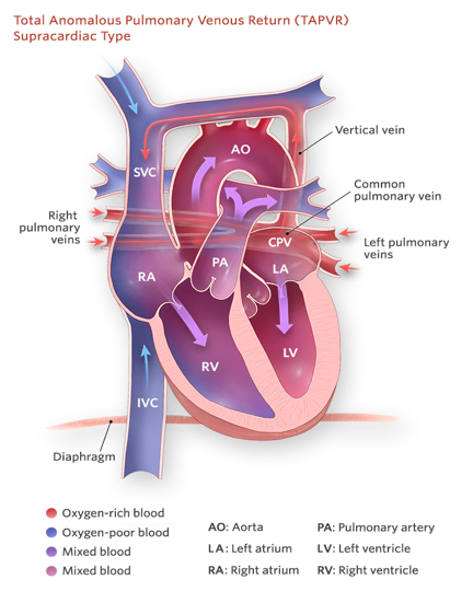 <p><strong><u>Mixed</u> Defect</strong></p><ul><li><p class="">Pulmonary veins do not connect to the left atrium.</p></li><li><p class="">Pulmonary veins connect to the right atrium or superior vena cava.</p></li><li><p class="">PFO or ASD is usually present.</p></li><li><p class=""><strong>Symptoms</strong>: </p><ul><li><p class="">Cyanosis</p></li><li><p class="">Fatigue</p></li><li><p class="">Poor feeding</p></li></ul></li></ul><p></p>