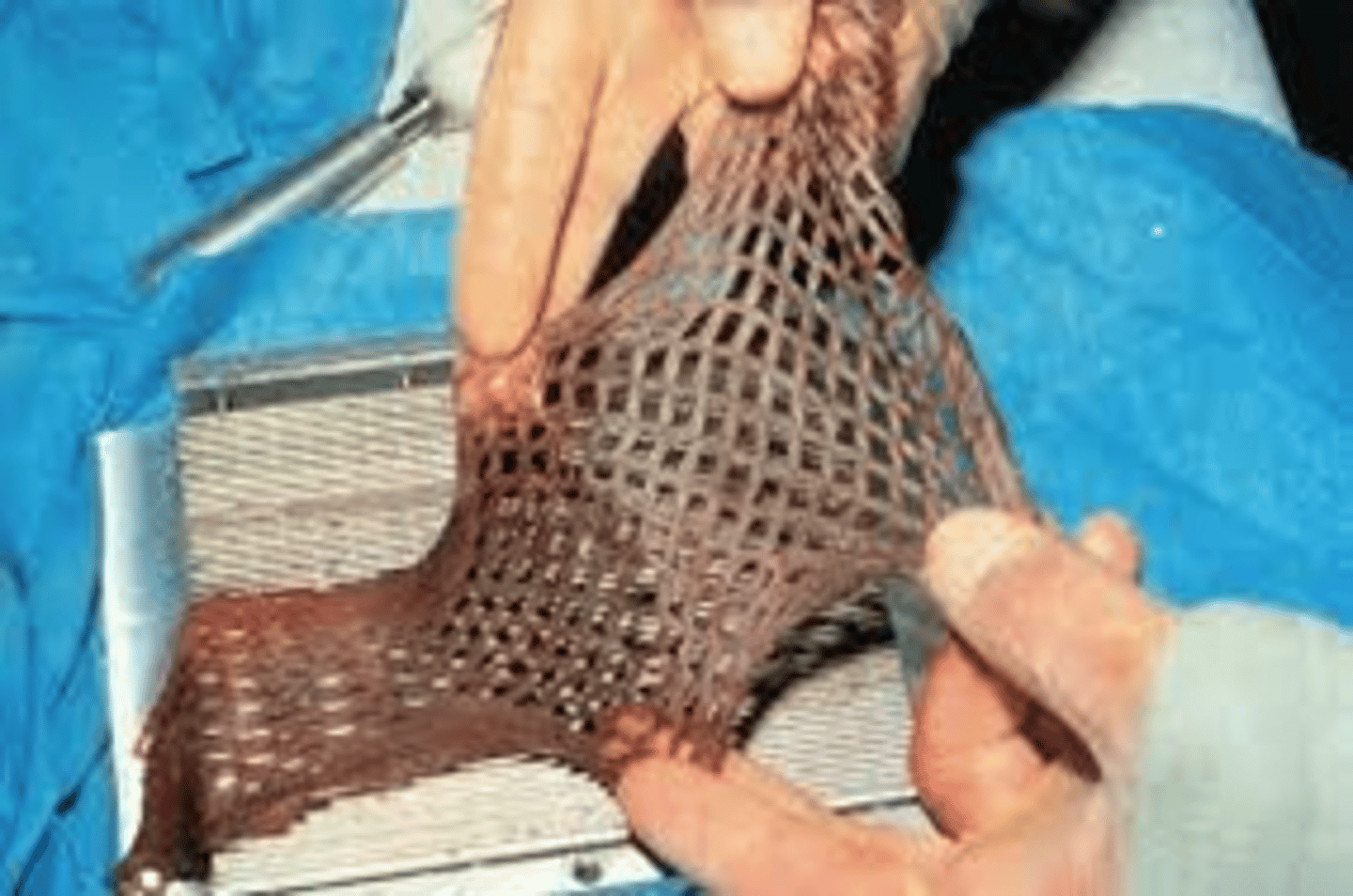<p>A skin graft that is altered to create a mesh-like pattern in order to cover a larger surface area</p>
