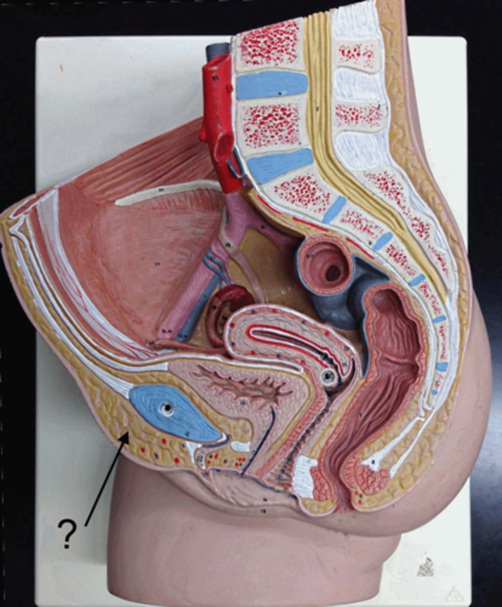 <p>deposit of adipose on pubic symphysis</p>