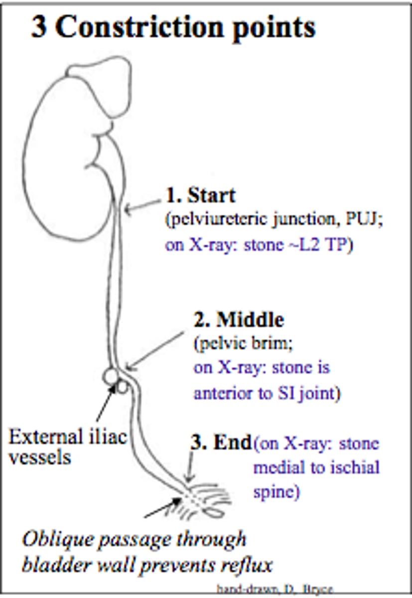 <p>narrowing of the ureter</p>