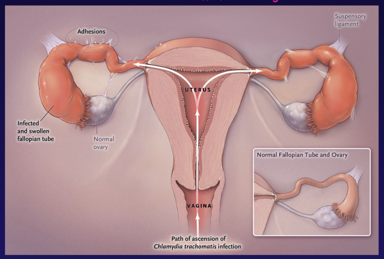 <ul><li><p>fallopian tube is infected and swollen </p></li><li><p>infertility </p></li><li><p>adhesion</p></li><li><p>vagina = path of ascension of chlamydia </p></li></ul><p></p>