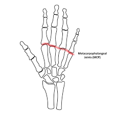 <p>Metacarpophalangeal (MP) Joint of affected digit</p>