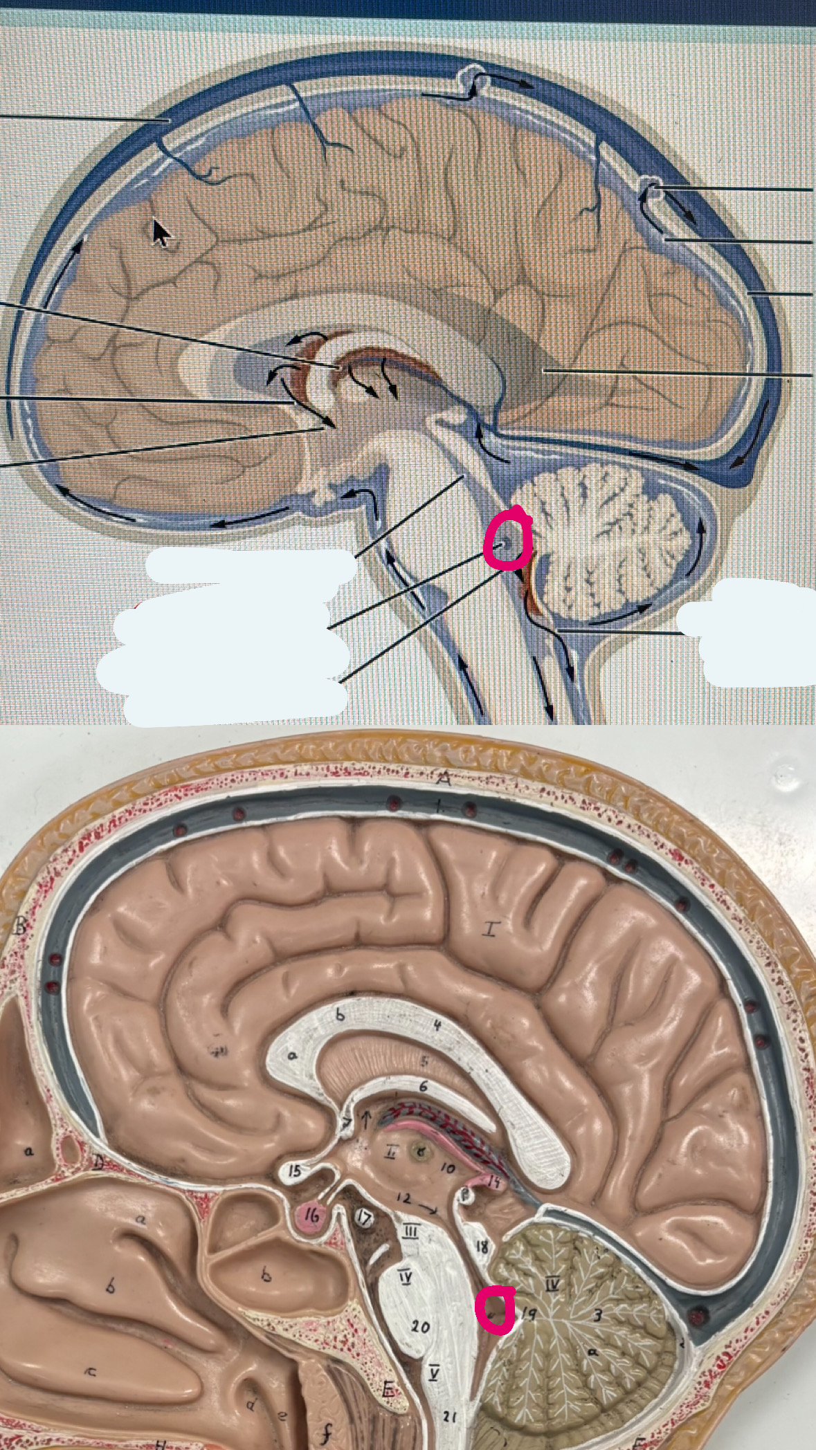 <p>the hole in the “fourth ventricle” space between the cerebellum and the brain stem</p>