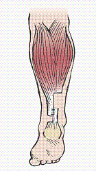 <p><span style="font-family: Lato Extended, Lato, Helvetica Neue, Helvetica, Arial, sans-serif">This picture shows Achilles Tendon Repair.</span></p>