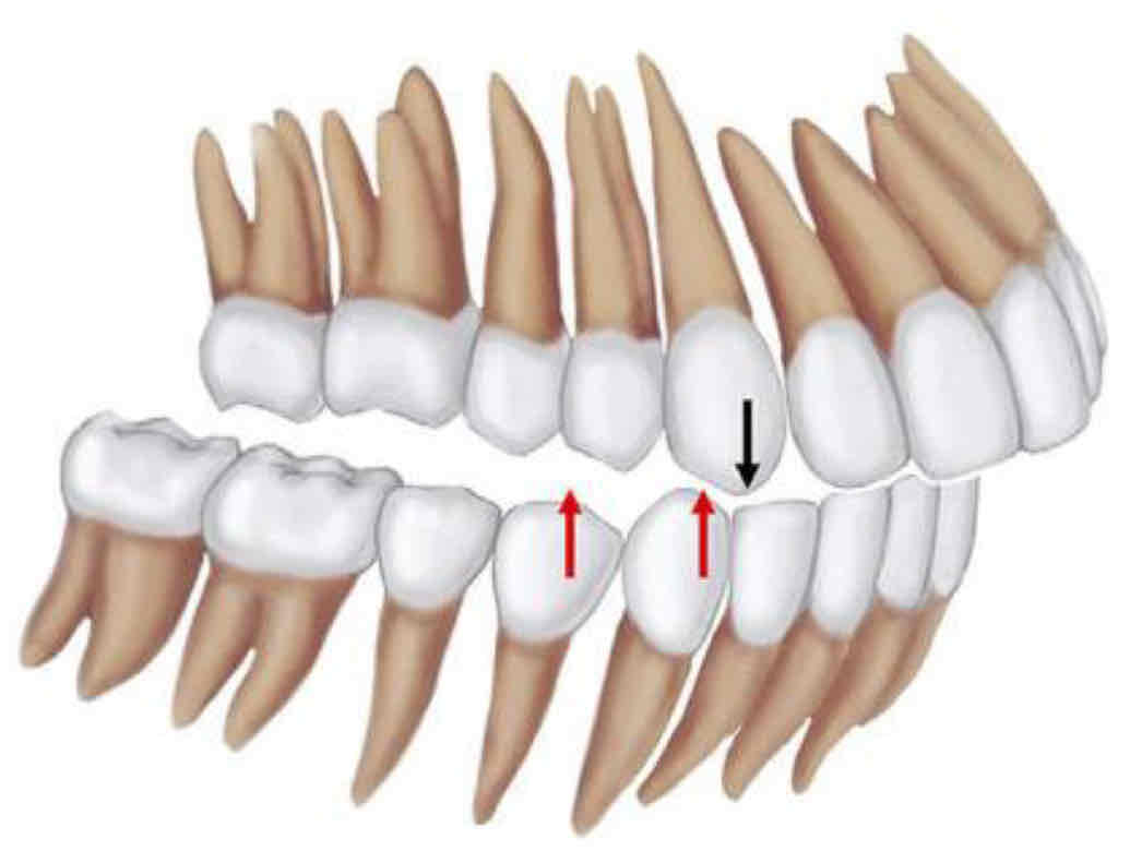 <p>class II occlusion</p>