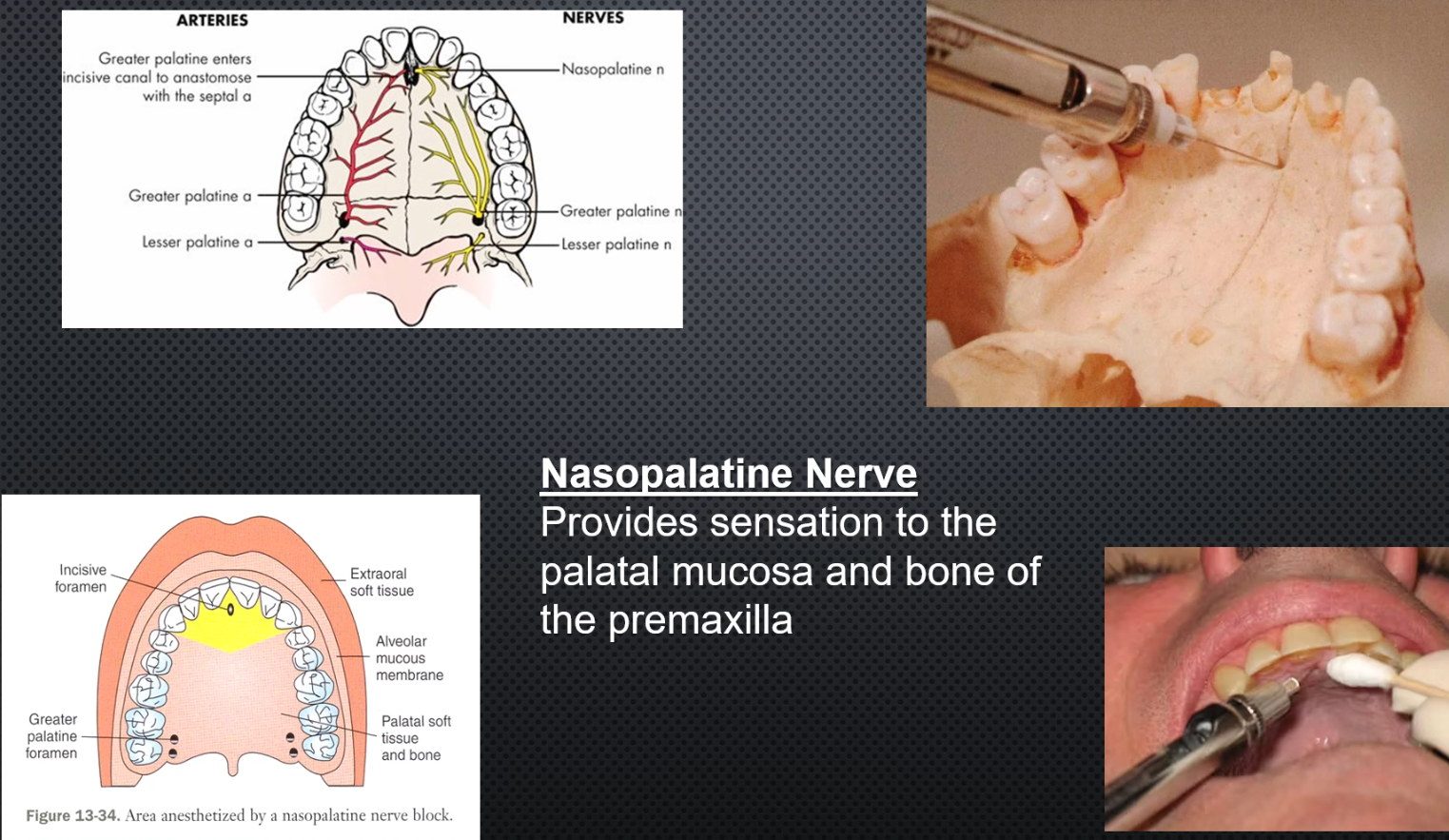 <ul><li><p>Area anesthetized: palatal mucosa and bone of the pre-maxilla</p></li><li><p>Procedure: Insert lateral to incisive papilla, do not enter foramen; asprate and deposit 0.5ml or until blanching</p></li><li><p>Onset of action:3-5min</p></li><li><p>Amount of anesthetic: max 0.45ml</p></li><li><p><mark data-color="red" style="background-color: red; color: inherit;">Epi: 1:50,000 not recommended!</mark></p></li></ul><p></p>