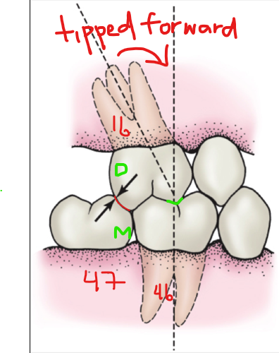 <ul><li><p>In permanent teeth, stolarized molars = <strong>when the upper 1M’s distal marginal ridge  touches the mesial marginal ridge of the lower 2M AND middle of the mand 1M </strong></p><ul><li><p><em>This is not normal — it shows a malocclusion.</em></p></li><li><p><em>Usually points toward a Class II tendency (lower molar sitting too far back).</em></p></li></ul></li></ul><p></p>