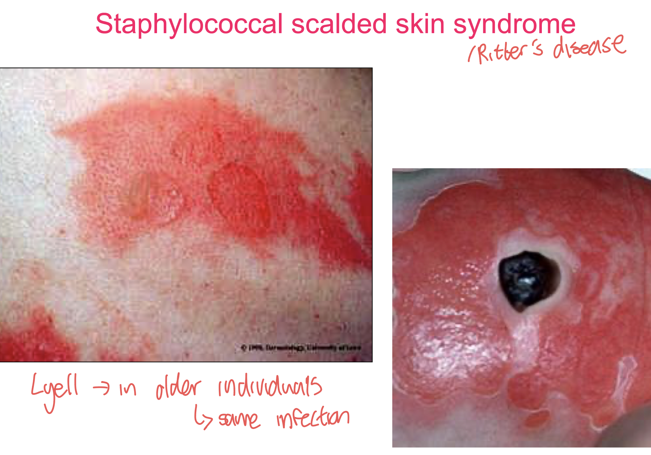 <p>• Most common in neonates and children under 8 years.</p><p>•<strong> Erythema with generalised flaccid bullae</strong> (fluid-filled lesion) <strong>formation caused by the epidermolytic toxin </strong>(a type A+B exfoliatin)</p><p>• <strong>Spontaneous bullae rupture with skin denudation </strong><span style="color: red;"><strong>(desquamation).</strong></span></p><p><strong>• Diffuse dermal involvement</strong></p>