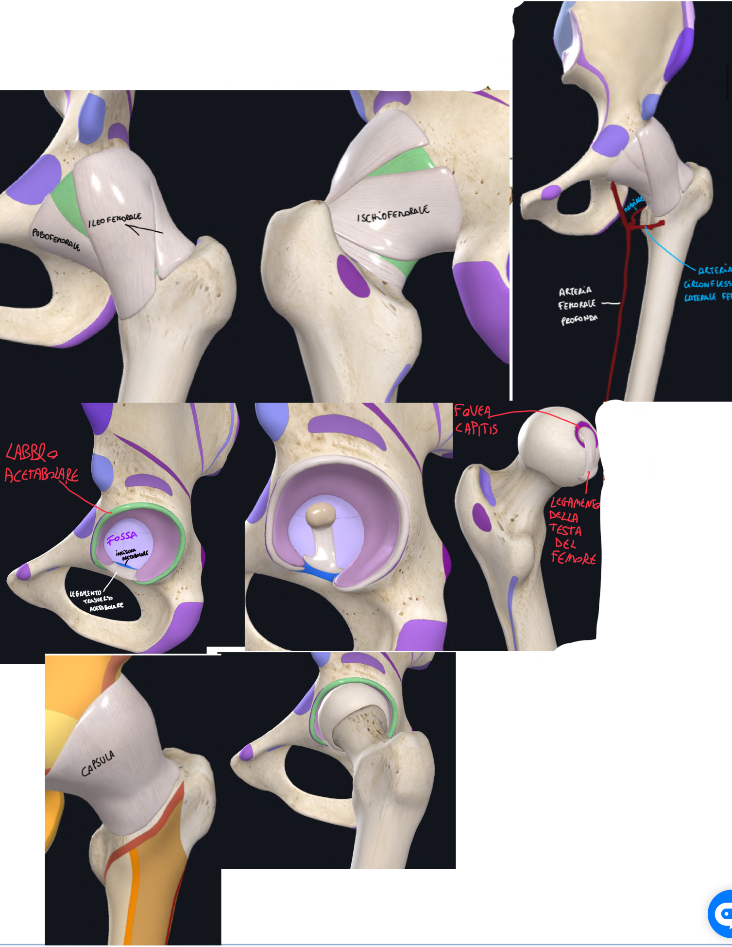 <p>E’ un’articolazione sinoviale enartrosi (diartrosi a sfera).</p><p>La differenza della spalla è che qui l’acetabolo è più profondo e accoglie gran parte della testa del femore → maggiore stabilità, ma minore mobilità.</p><p>Superfici articolari (rivestite da ialina):</p><ul><li><p>Acetabolo dell’Anca → superficie articolare detta faccia semilunare.</p><ul><li><p>Ha forma di ferro di cavallo, cioè è interrotta dall’insicura dell’acetabolo, ma completata dal Legamento Trasverso dell’Acetabolo.<br>La cavità è approfondita dal Labbro Acetabolare.</p></li></ul></li><li><p>Testa del Femore → Al centro presenta la Fovea Capitis dove si inserisce il Legamento della Testa del Femore che origina dal legamento trasverso e incisura acetabolare</p></li></ul><p>CAPSULA ARTICOLARE:</p><ul><li><p>Si inserisce su margine e labbro acetabolare, legamento trasverso, linea e cresta intertrocanterica</p></li><li><p>Conferisce stabilità all’articolazione</p></li></ul><p>Legamenti:</p><ul><li><p>Legamento Ileofemorale → a forma di Y. dalla spina iliaca anteriore inferiore alla linea intertrocanterica. </p><ul><li><p>E’ il più robusto e limita l’estensione.</p></li></ul></li><li><p>Legamento Pubofemorale → forma triangolare, dal ramo superiore del pube ed eminenza ileopubica alla linea intertrocanterica. </p><ul><li><p>Limita l’abduzione.</p></li></ul></li><li><p>Legamento Ischiofemorale → forma spiraliforme, dal corpo dell’ischio al grande trocantere. </p><ul><li><p>Limita la rotazione interna.</p></li></ul></li></ul><p>VASCOLARIZZAZIONE TESTA DEL FEMORE:</p><ul><li><p>Il legamento della testa del femore nella fovea capitis dà passaggio a piccoli vasi importanti nella prime fasi dello sviluppo, poi quando la testa del femore è ossificata, si obliterano.</p></li><li><p>Quindi la principale fonte di vascolarizzazione della testa del femore diventa l’Arteria Femorale Profonda, il particolare il suo ramo, cioè l’ARTERIA CIRCONFLESSA MEDIALE.</p></li></ul><p></p>