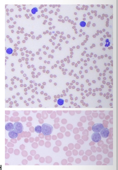 <p>Clonal proliferation of lymphocytes, leukocytes + their precursors (lymphoid + myeloid origin)</p>