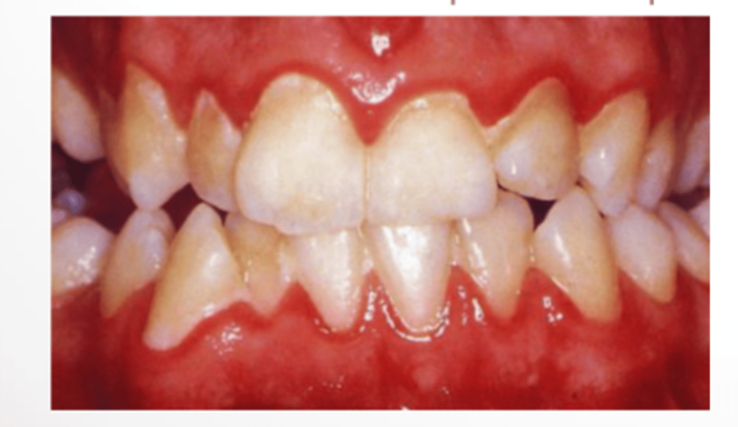 <p>- thin plaque (translucent + invisible)</p><p>- stained plaque (yellow, green, tobacco)</p><p>- thick plaque, tooth appears dull, dingy and matted-fur like</p>