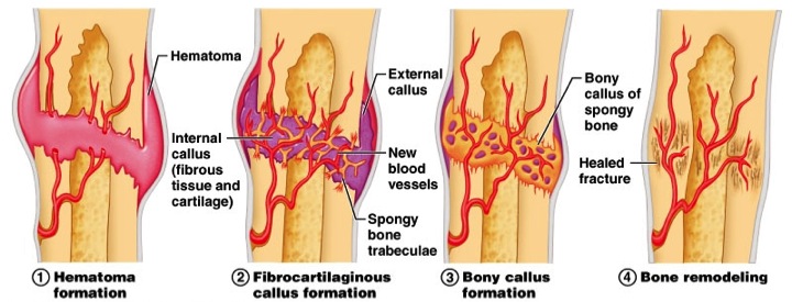<p>1. hematoma formation</p><p>2. fibrocartilage callus formation</p><p>3. bony callus formation</p><p>4. bone remodeling</p>