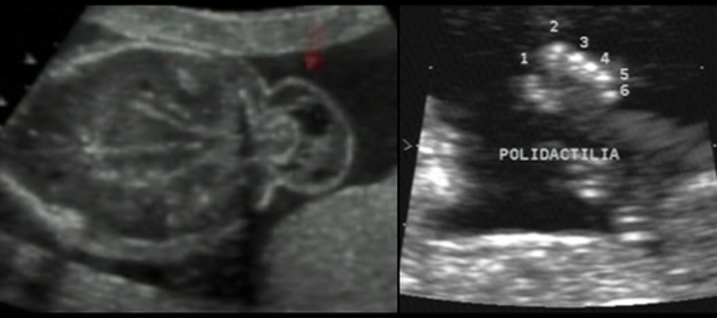 <p>A fatal condition characterized by encephalocele, polydactyly, and cystic dysplastic kidneys.</p>