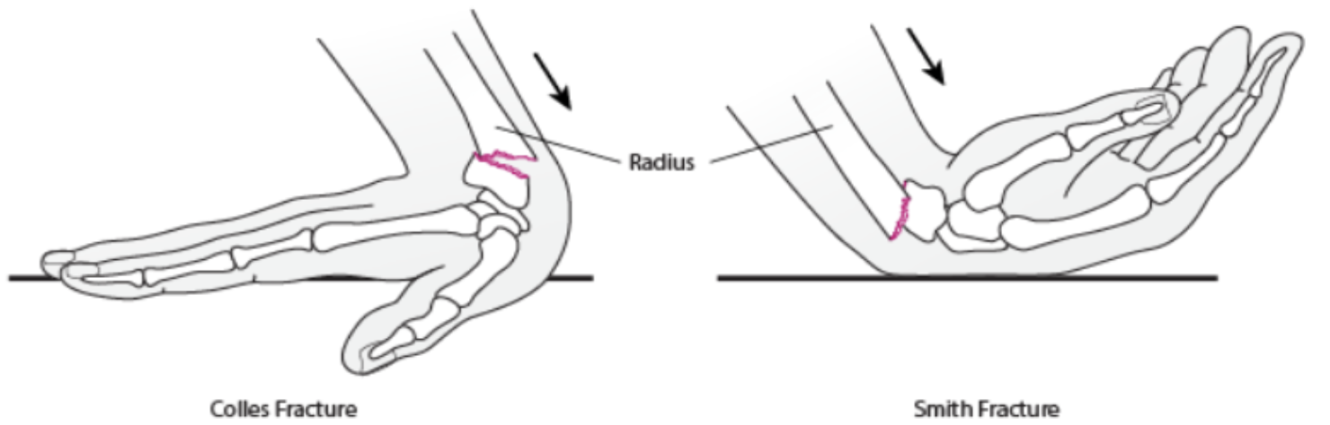 <ol><li><p>Smith’s fracture (garden spade deformity) →radius dislocated volarly</p><p></p></li></ol><p><span data-name="cross_mark" data-type="emoji">❌</span>Colles fracture (dinner fork deformity) →radius dislocated dorsally </p>