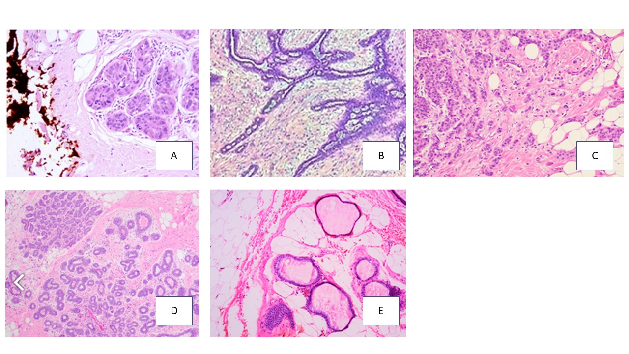 <p><span>Which of the following H&amp;E images shows and invasive infiltrating carcinoma?</span></p><p>a. Image A</p><p>b. Image B</p><p>c. Image C</p><p>d. Image D</p><p>e. Image E</p>