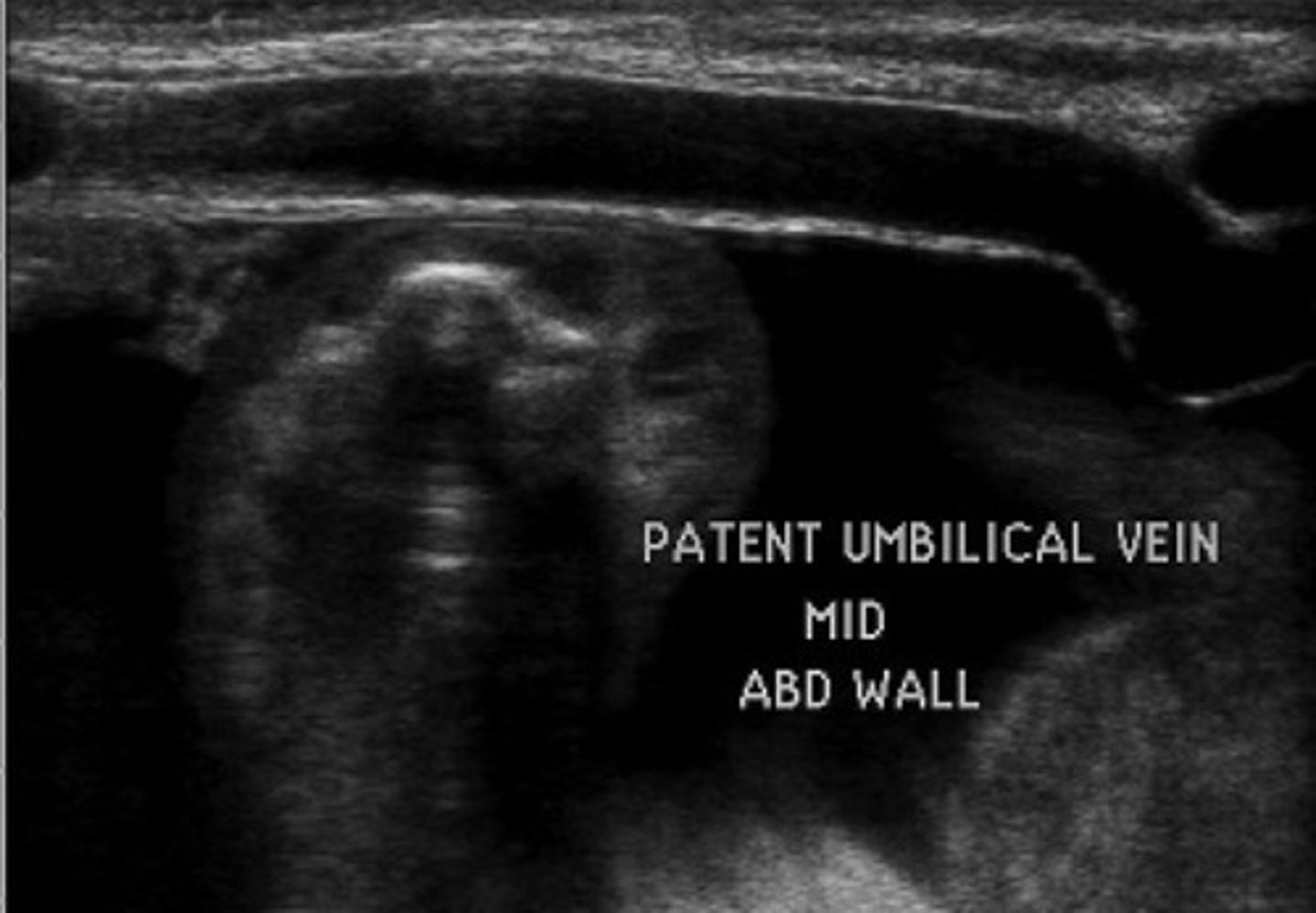<p>Ligamentum teres recanalizes</p><p>Courses from left portal vein to anterior abdominal wall</p><p>Hepatofugal flow</p>