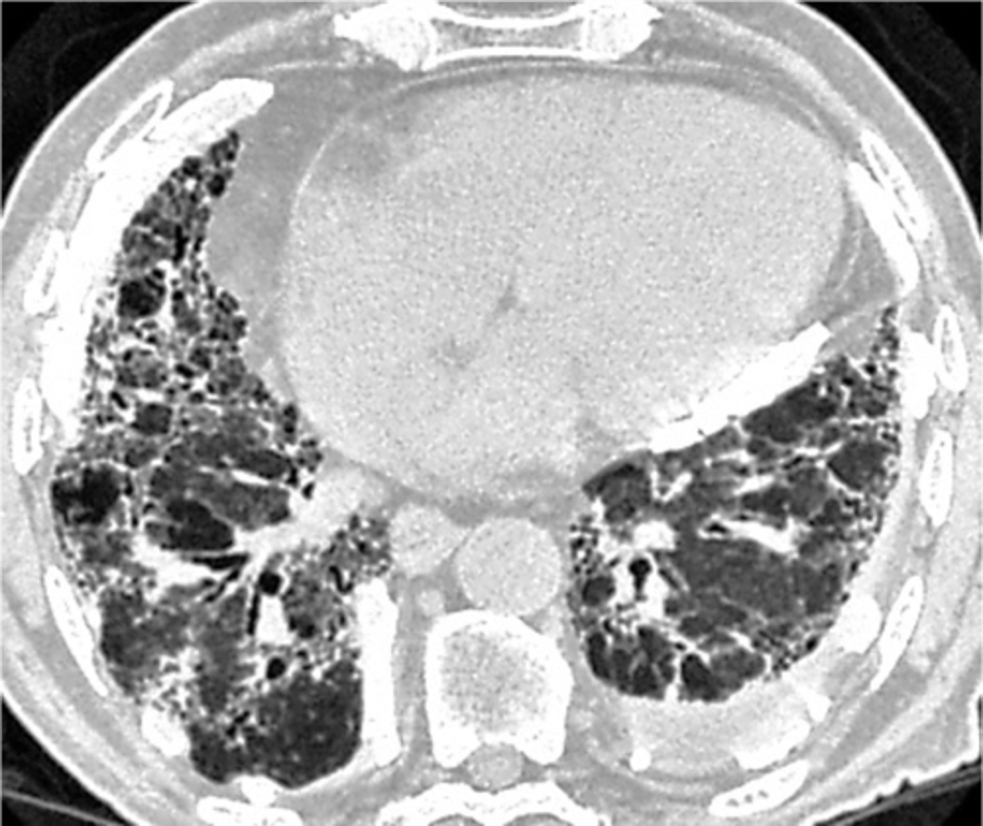 <p>asbestosis</p>