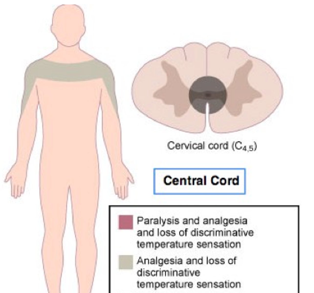 <p>Central Cord Syndrome </p>