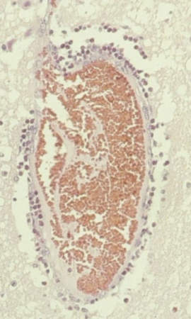 <p>eosinophilic meningoencephalitis (perivascular eosinophilic cuffing)</p>