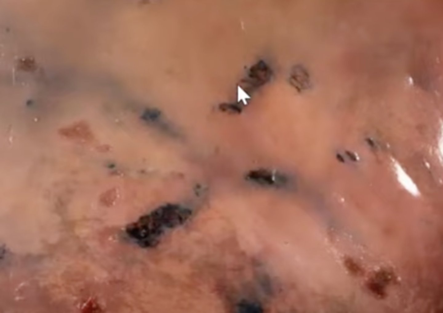 <p>What caused this lesion in the liver of a deer?</p>