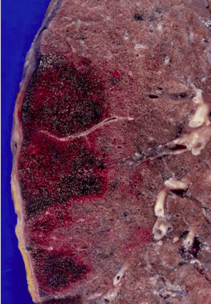 <p>- Occurs in organs with dual blood supply</p><p>- Occurs in organs with numerous anastomoses </p><p>- Characteristic of lung and GIT</p><p>- Can be caused by venous occlusion </p>