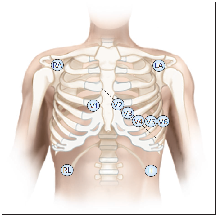 <p>Placement of electrodes for exercise cardiography</p>