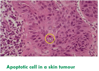 <ul><li><p>shrinkage necrosis (no inflammation/other degenerative changes)</p></li><li><p>a controlled process of cell death, programmed into cells to occur at a certain stage in their life cycle</p></li><li><p>death inducing signals are more dominant than cell surviving signals</p></li></ul><p></p>