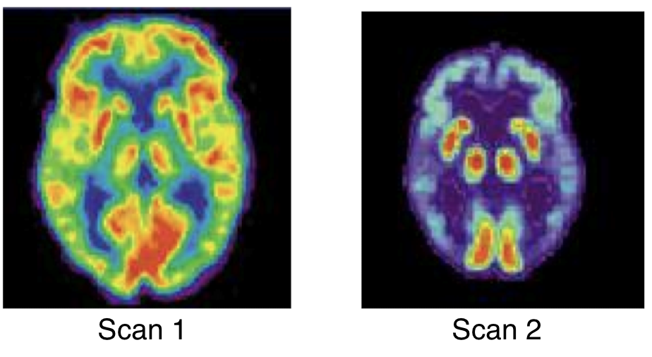 <p>Which is the healthy brain and which is the Alzheimer’s brain?</p>