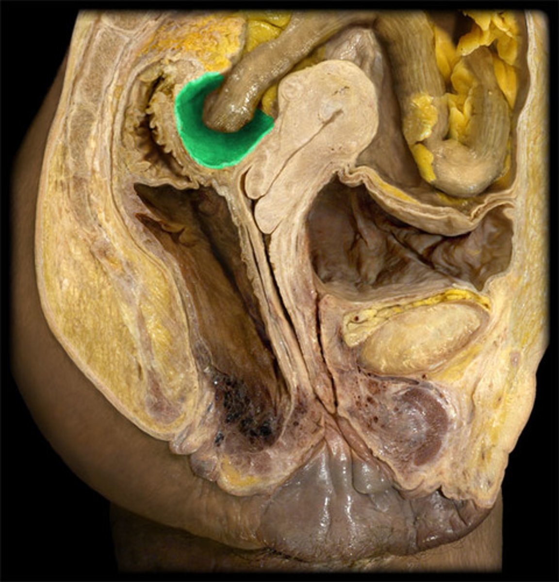 <p>the pocket formed between the posterior wall of the uterus and the anterior surface of the colon</p>