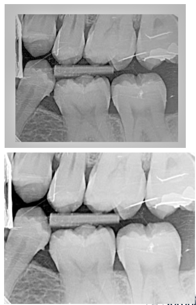 <p>Aka Exposure Error </p><ul><li><p>film appears too bright with many shades of grey. </p></li><li><p>Fix: check kVp on control panel </p></li></ul><p></p>