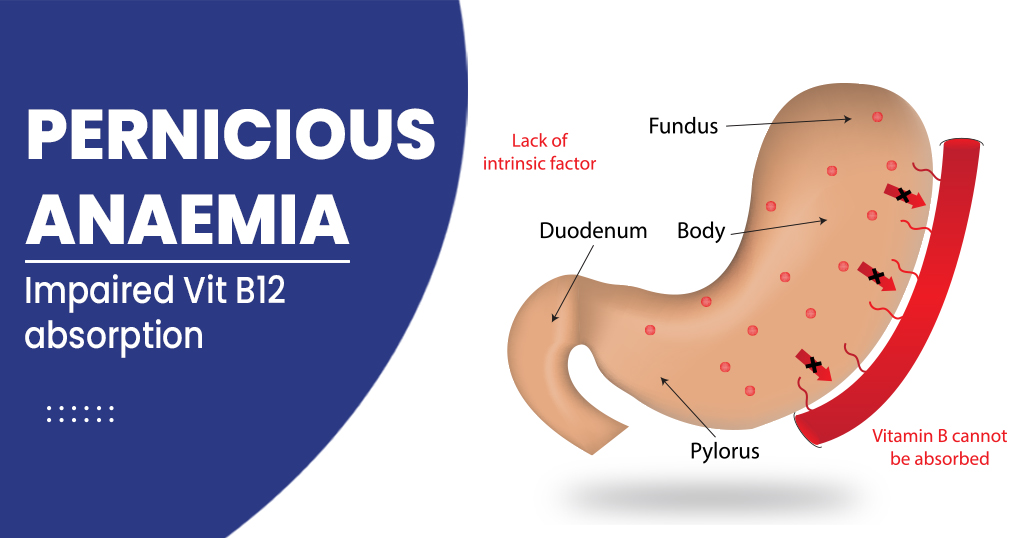 <p>What is Pernicious Anemia?</p>