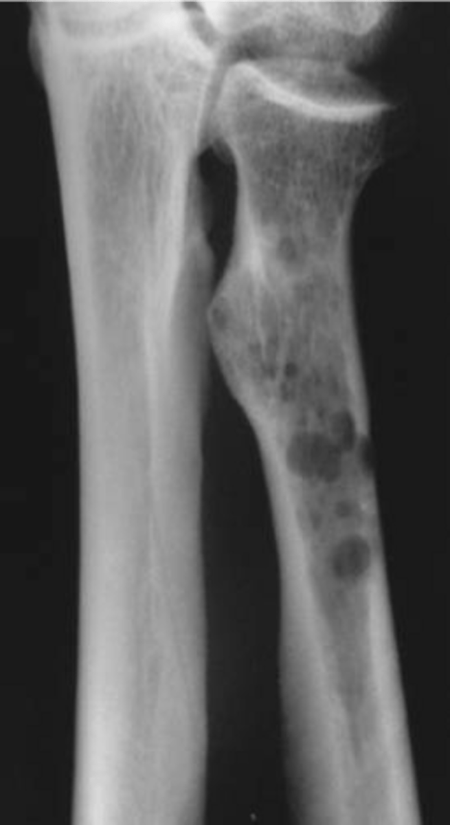 <p>State the late imaging findings of multiple myeloma</p>