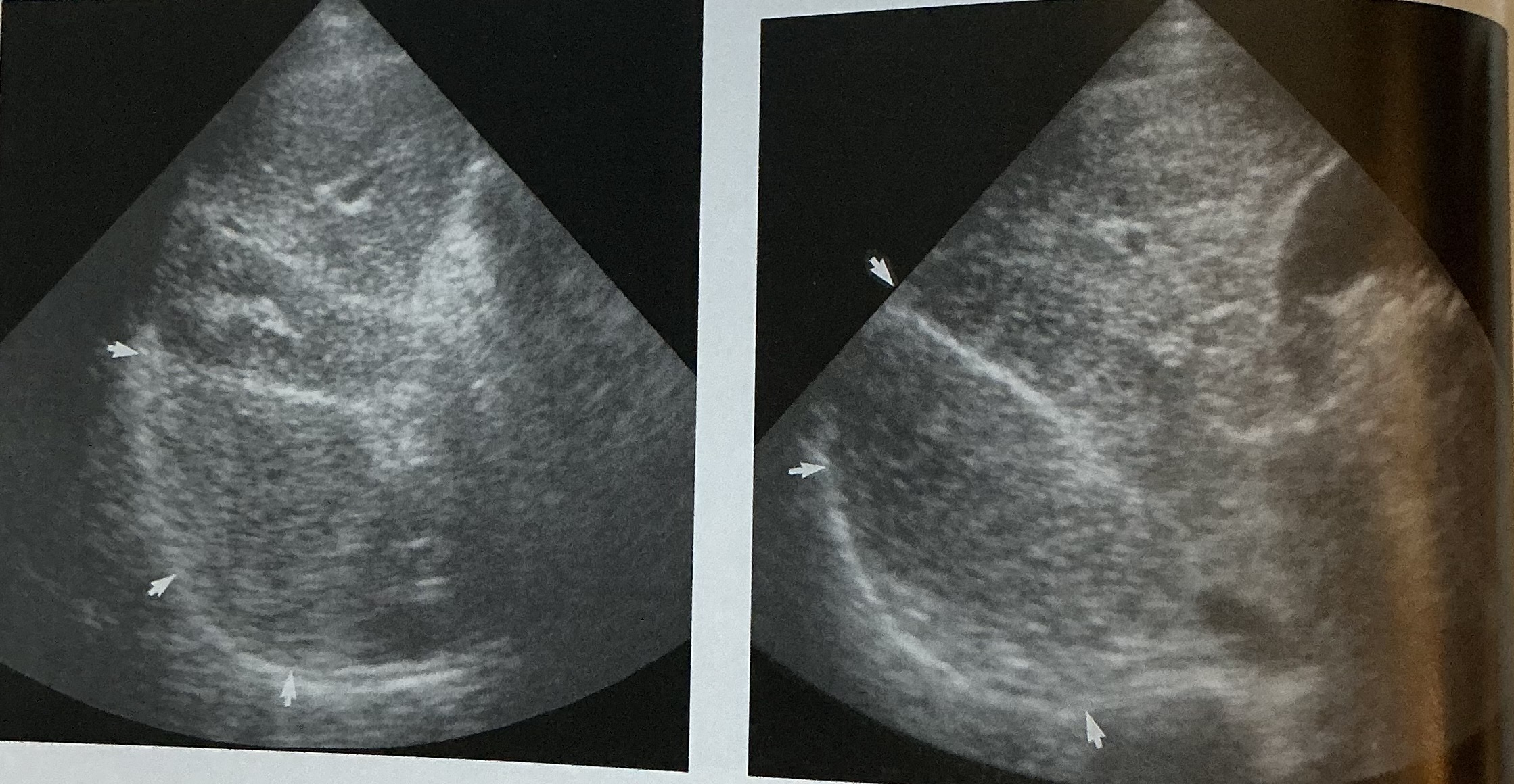 <p>What pathology is this photo depicting? What is the sign that can be seen in this pathology? What type of infection is this?</p>
