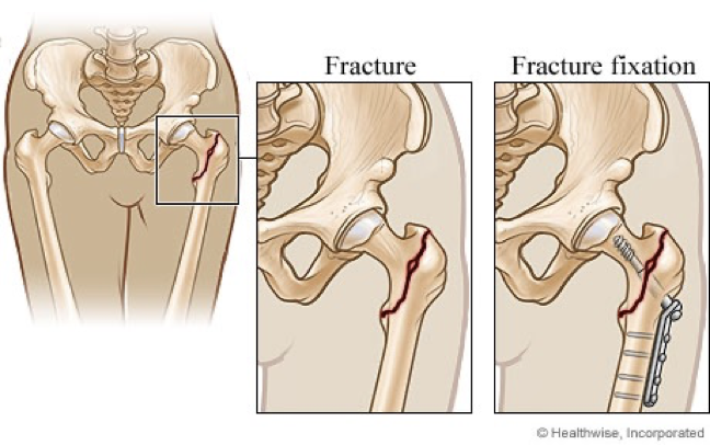 <p>open reduction and internal fixation (ORIF) </p>