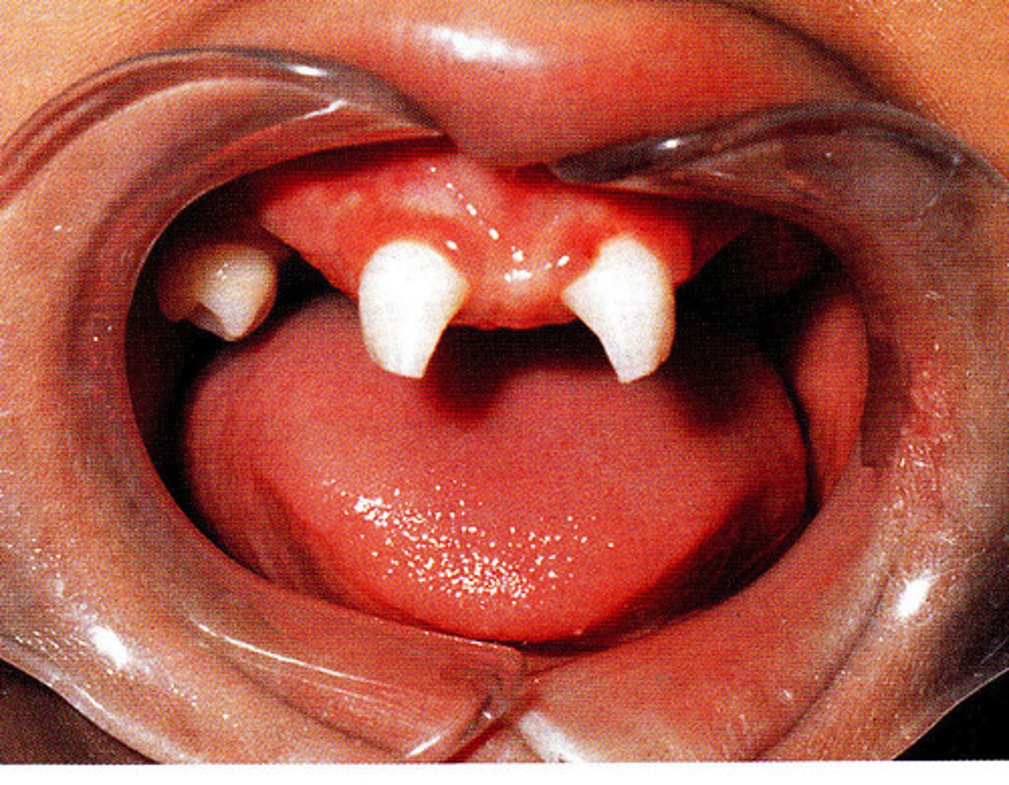 <p>ectodermal dysplasia</p>