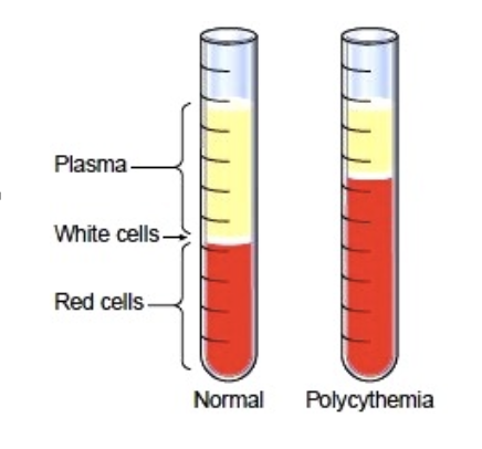 <p>high RBC count, blood becomes thick “sludge”</p>