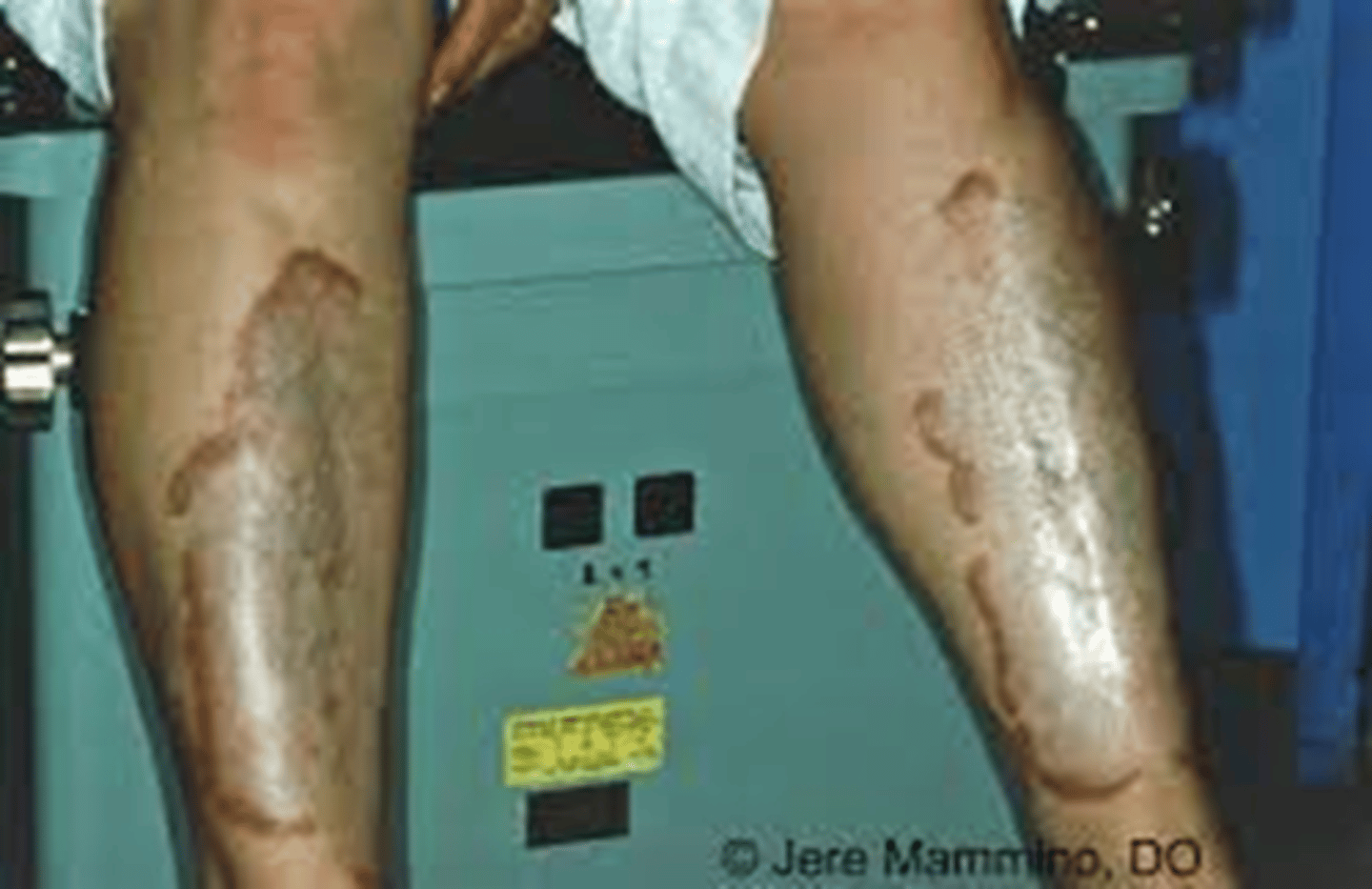 <p>Appears similar to diabetic dermopathy but is fewer, larger, deeper, &amp; may be itchy, painful, or open up; may develop secondary to DM</p>