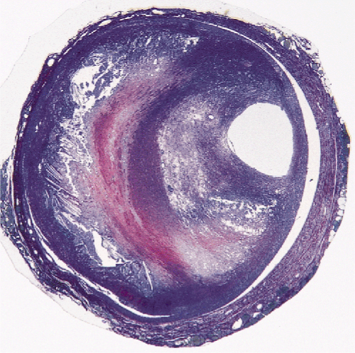 <p>thrombogenic lipid core </p>