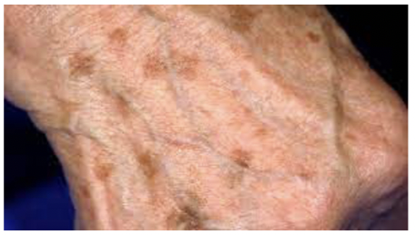 <p>flat pigmented brown circle; freckle</p>