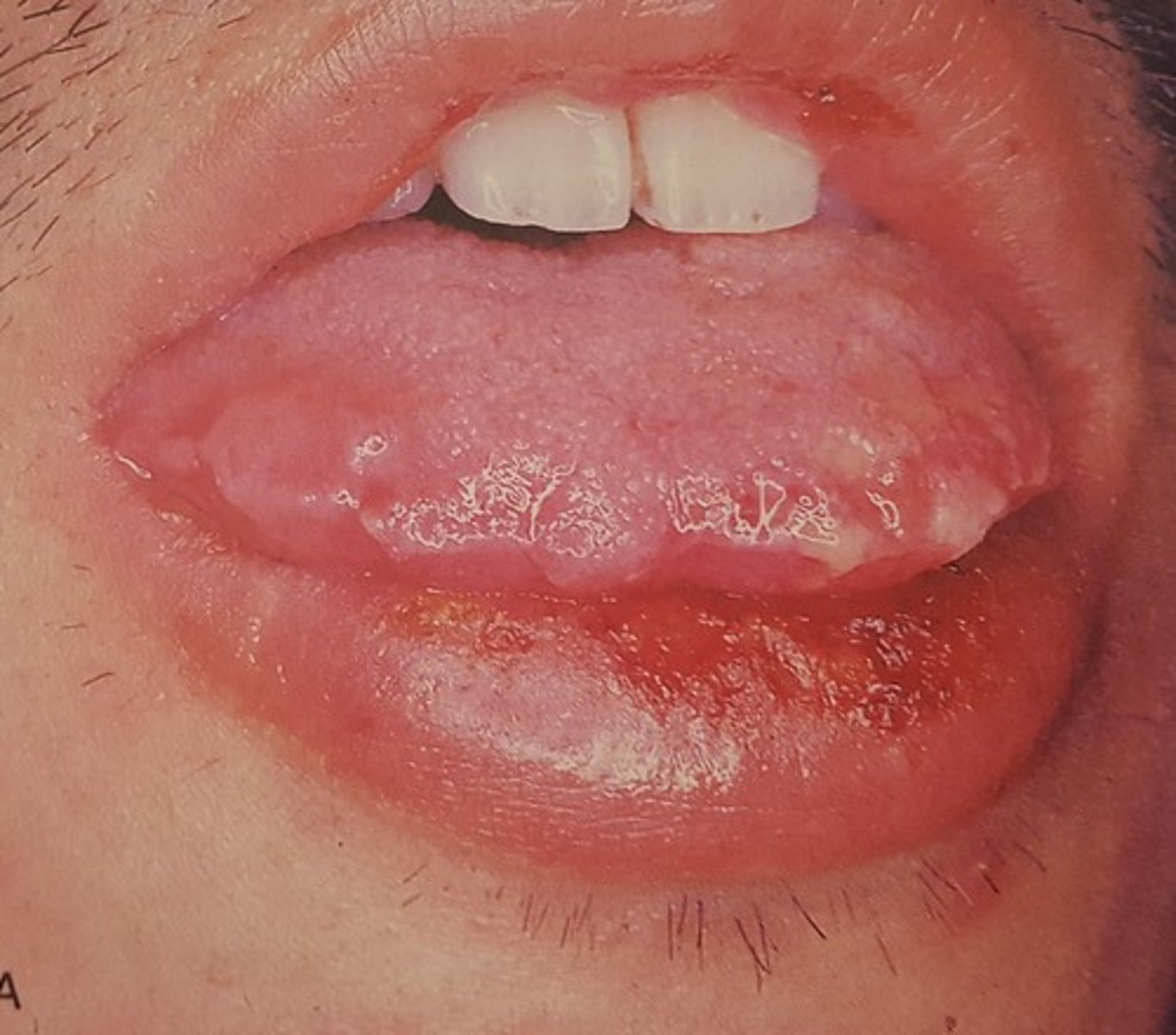 <p>Hint: Begins with target lesions on extremities</p>