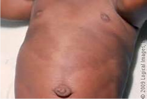 <p><strong>Cafe au last spots are usually benign, but ≥6 large spots are present can be associated with what condition?</strong></p>