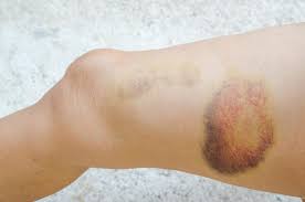 pocket of blood built up under skin, in arteriols
