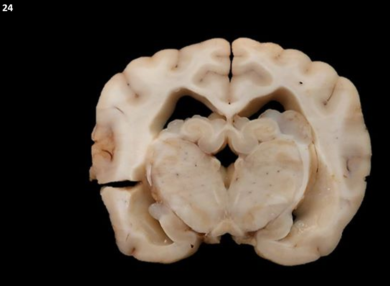 <p class="MsoNormal">24.<span>&nbsp; </span>Tissue from a dog.<span>&nbsp; </span>The most appropriate gross diagnosis in this case would be an interventricular<span>&nbsp; </span>_________:</p><ol type="a"><li><p>Astrocytoma</p></li><li><p><span>Oligodendroglioma</span></p></li><li><p>Ependymoma</p></li><li><p>Meningioma</p></li></ol><p></p>