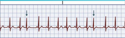 
Abnormal Contraction starting from ectopic focus
(atria)